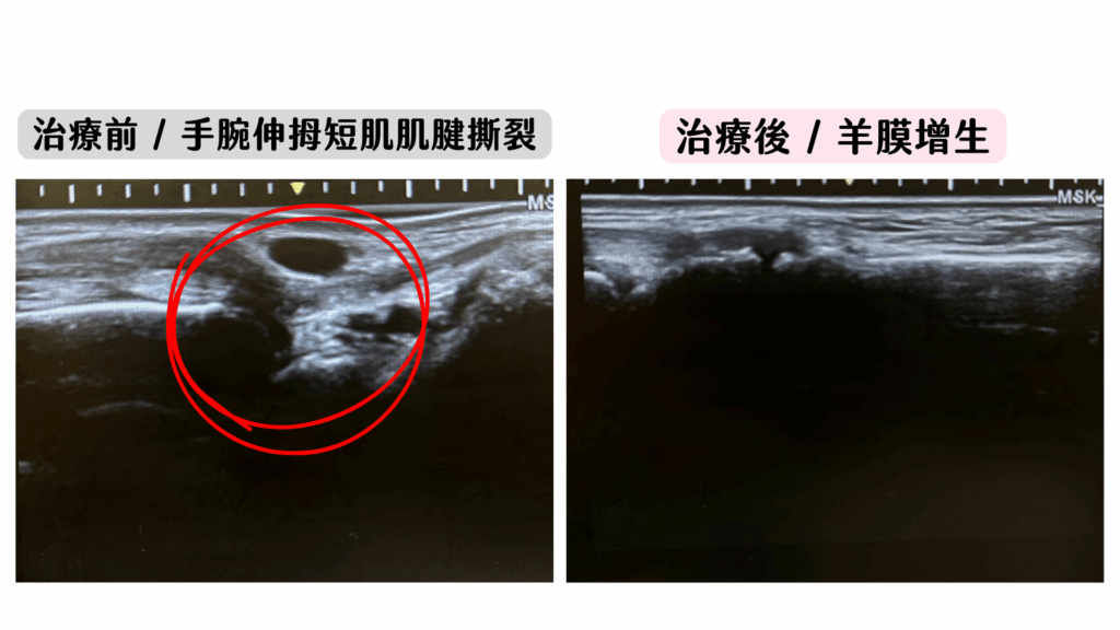 羊膜增生療法