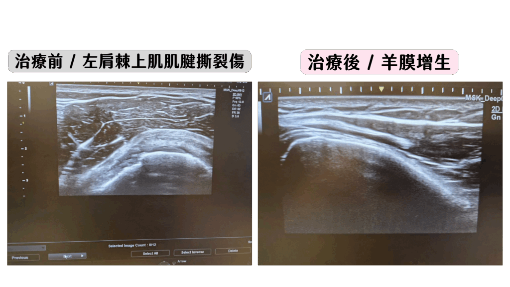 羊膜增生療法