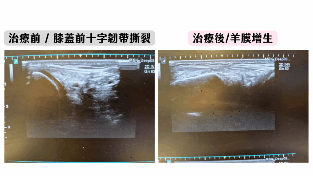 前十字韌帶撕裂